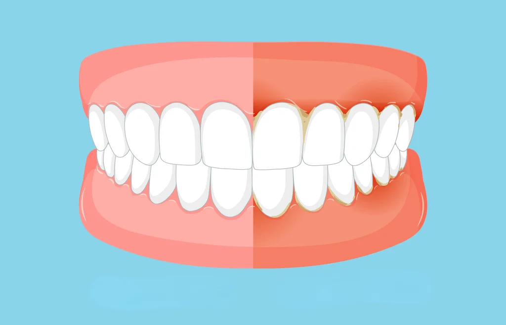 Sangrado de encías: cuándo preocuparse y qué hacer